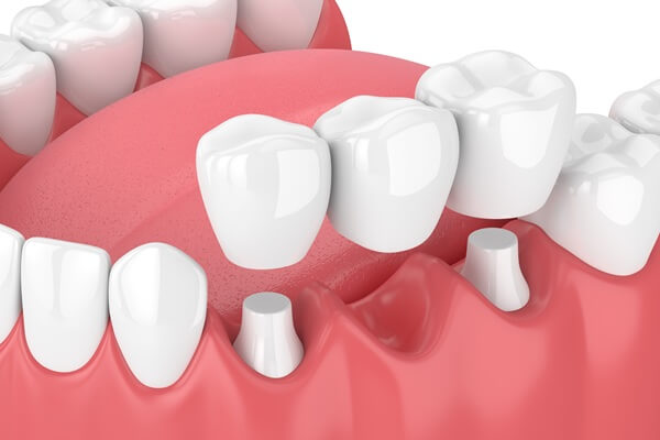 dental-bridges-paramount-dentistry-at-stonechurch