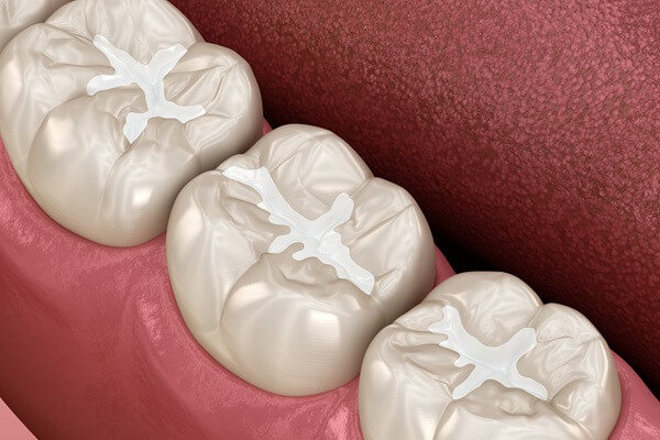 dental-fillings-paramount-dentistry-at-stonechurch