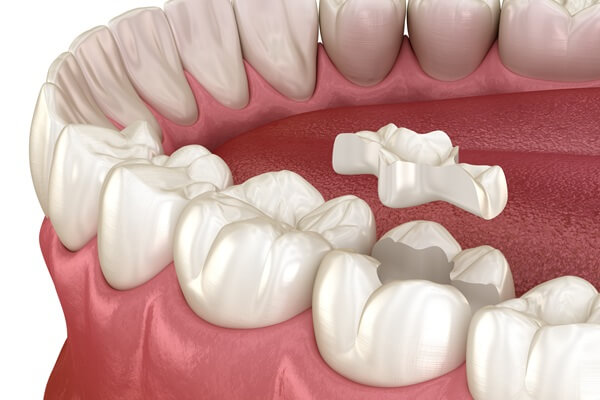 inlays-onlays-paramount-dentistry-at-stonechurch