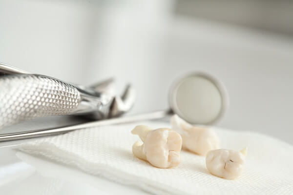 tooth-extractions-paramount-dentistry-at-stonechurch