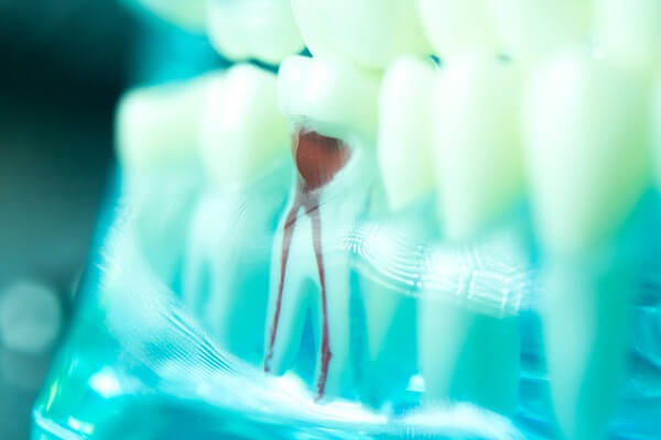 what-happens-during-visit-root-canal-therapy